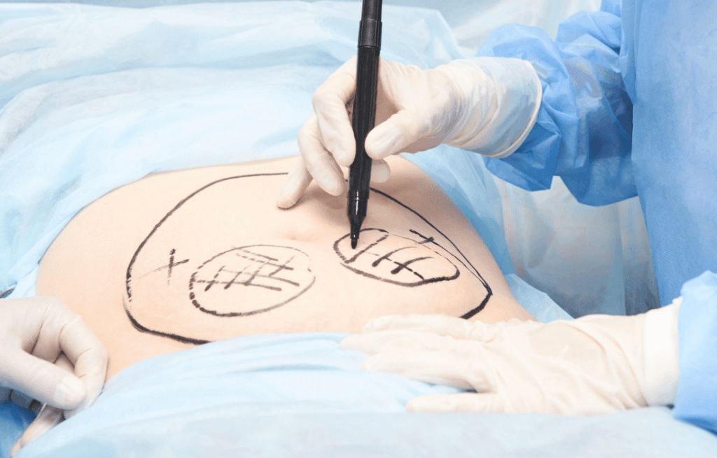 Abdominoplasty or Tummy Tuck Surgery