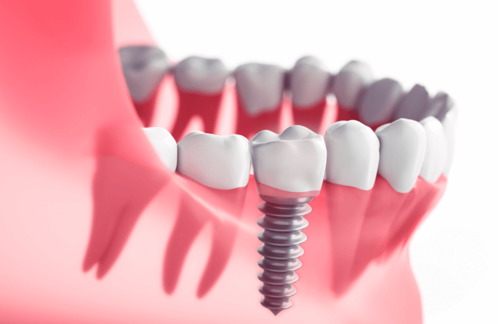 Dental Implants