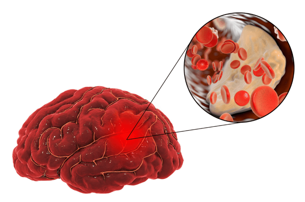 Cerebrovascular Diseases​