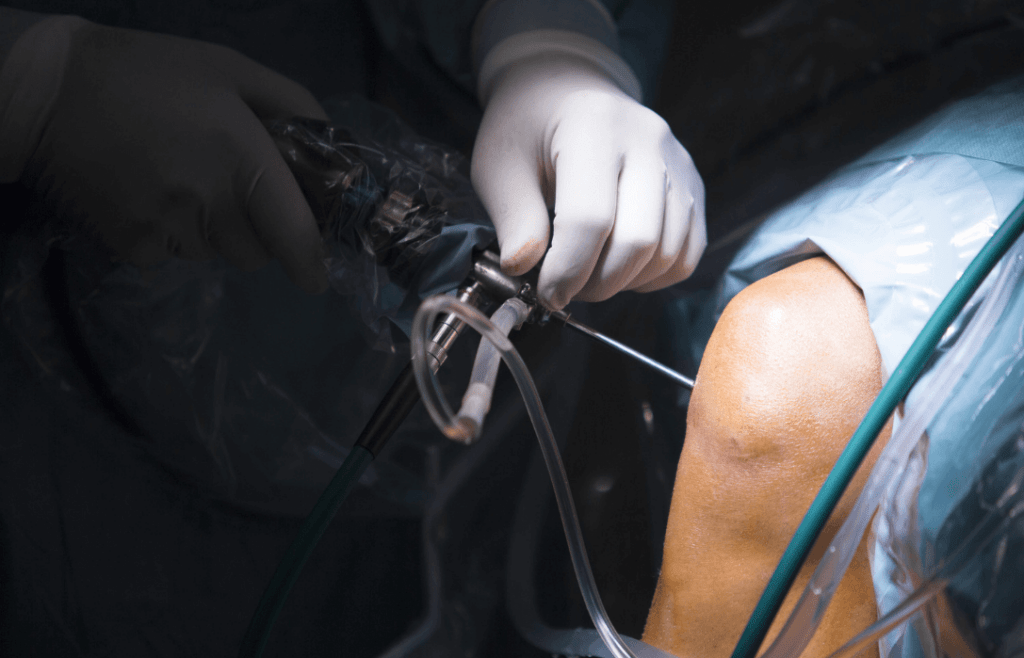 Arthroscopic Surgery